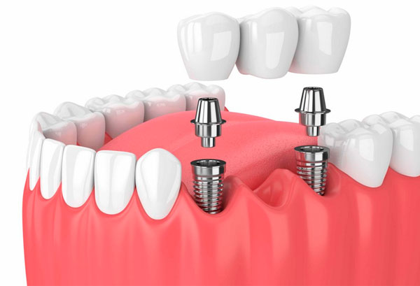 Восстановить зубы на нижней челюсти