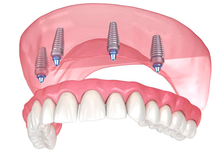Способы имплантации верхних зубов
