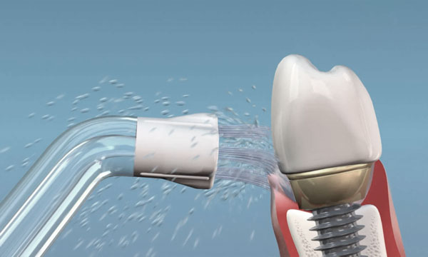 Несъемное протезирование зубов рекомендации