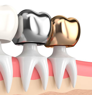 Несъемные зубные протезы - Коронки на зубы