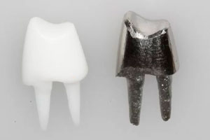 Несъемные зубные протезы - Штифтовые вкладки