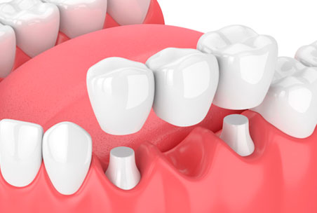 Несъемные зубные протезы - Мостовидный протез