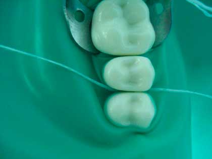 Использование коффердама при лечение каналов зуба