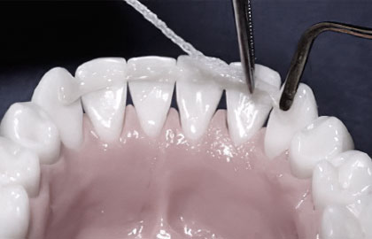 Шинирование зубов в минской стоматологии