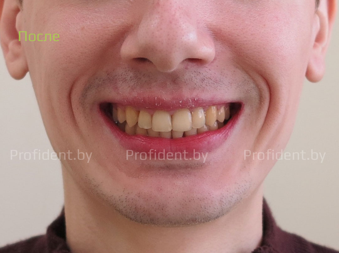 Ортодонтическое лечение самолигирующими брекетами и эстетическая реставрация зубов