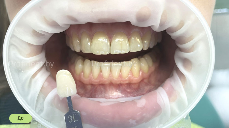 Отбеливания зубов с использованием современного аппарата Beyond Polus