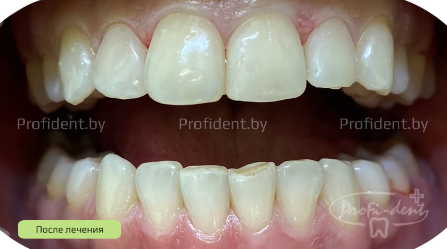 Фотоотбеливание и реставрация передних зубов