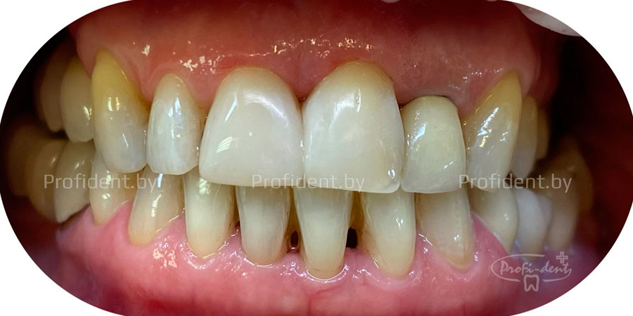 Эстетическая реставрация двух центральных зубов верхней челюсти