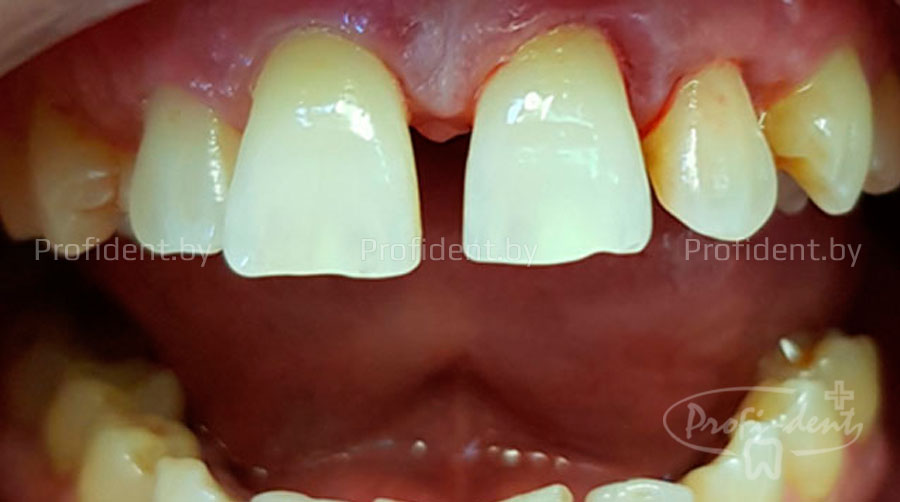 Лечение периодонтита и эстетическая реставрация передних зубов