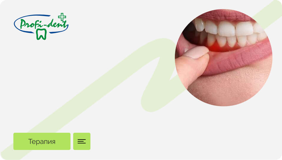 Если не будете лечить десну, рискуете потерять зубы