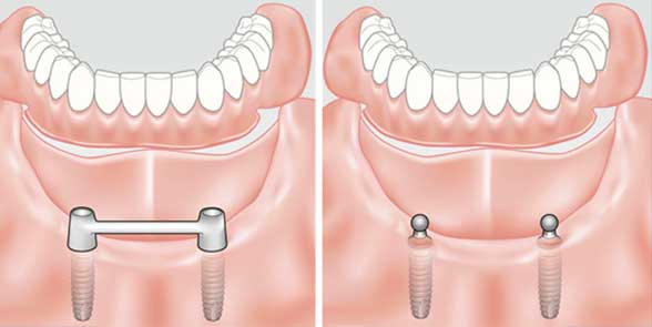 Варианты протезирования при полной потере зубов 