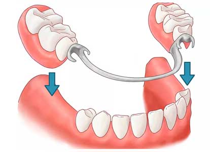 Варианты протезирования при полной потере зубов 