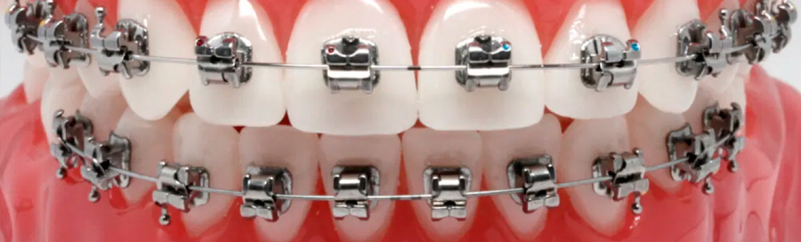 Виды брекет-систем. Безлигатурные брекеты