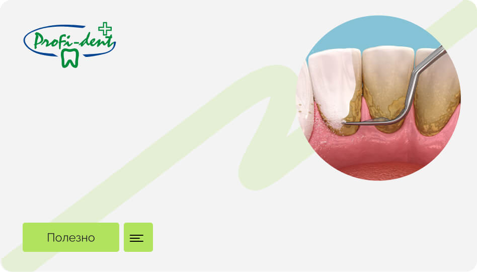 Как убрать налет на зубах