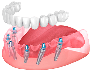 Полная имплантация зубов All-On-4 и All-On-6