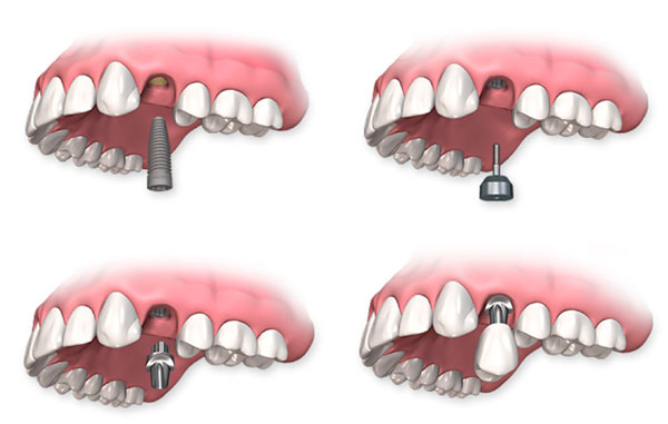Имплантация зубов