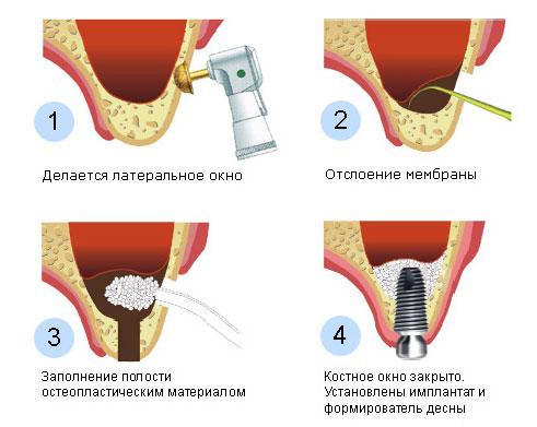 Открытый синус лифтинг, этапы, цена в Минске