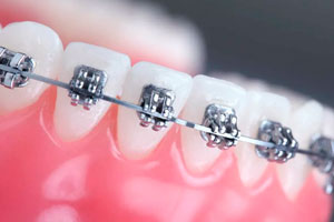 Установка брекет-систем