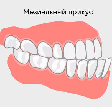 Исправить мезиальный прикус в Минске