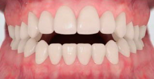 Виды открытого прикуса и их лечение