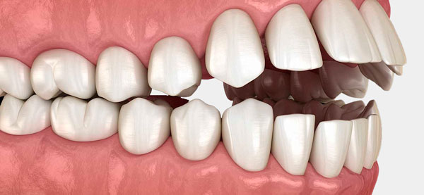 Исправить открытый прикус в Минске