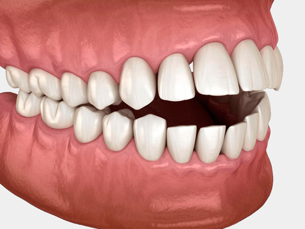 Лечим открытый прикус