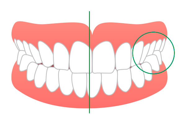 Виды перекрестного прикуса