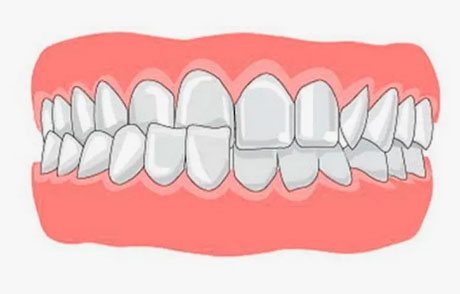 Исправить перекрестный прикус в Минске