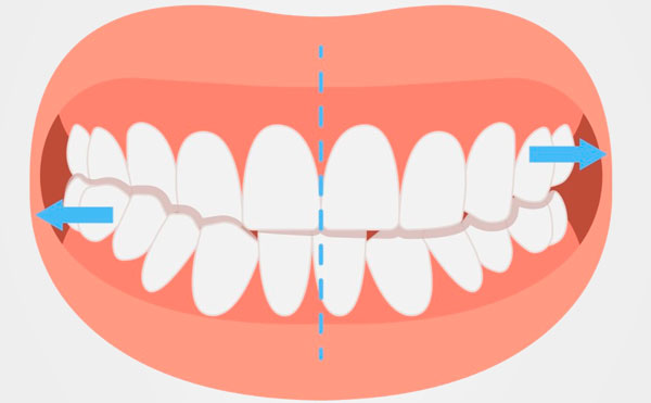исправить перекрестный прикус