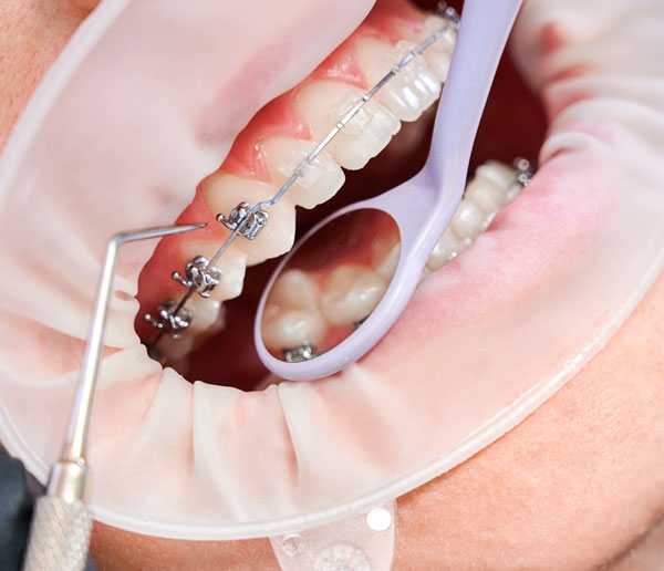 Коррекция брекетов