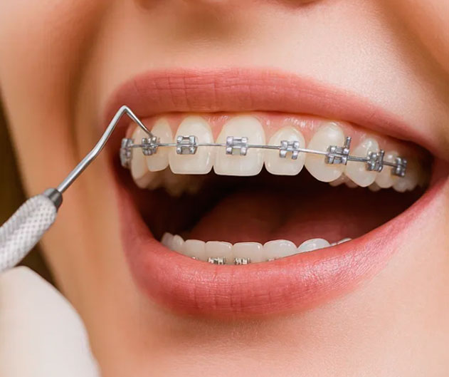 Коррекция брекетов как часто