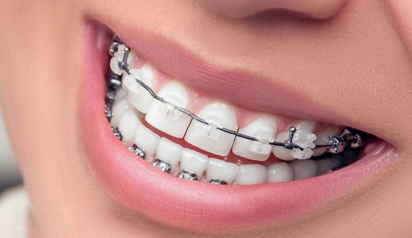 Коррекция брекетов после установки