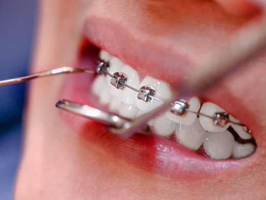 Снятие брекетов с зубов
