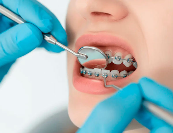 Снятие брекетов