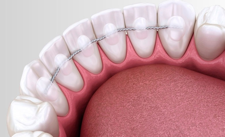 Лечим открытый прикус