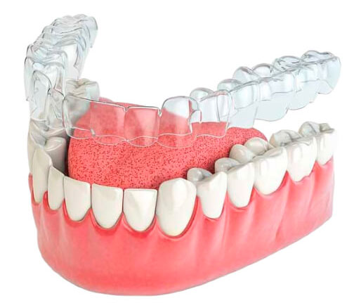 Съемные ретейнеры - каппы