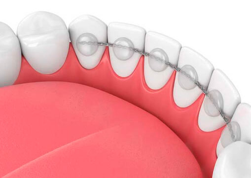 Несъемные ретейнеры