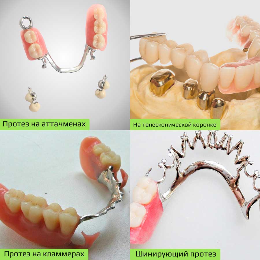 Протез на аттачменах. Аттачменты для бюгельных протезов. Бюгельный на аттачменах. Аттачмены для бюгельных протезов.