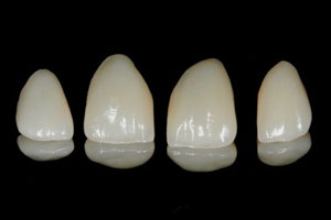 Коронки E-max Керамические коронки E-max на зубы в Минске, цены