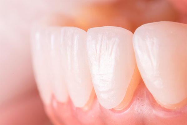 Установка виниров