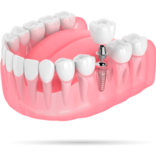 Восстановление зубов на штифте, наращивание зубов на штифт | Стоматология Белый Кит