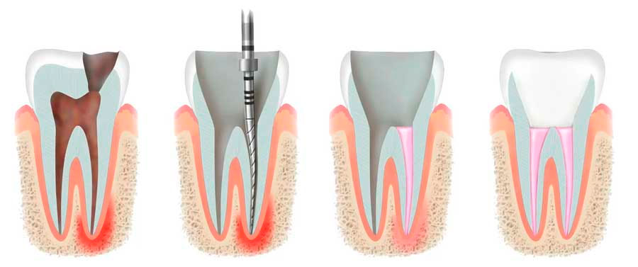 Этапы лечения каналов зуба