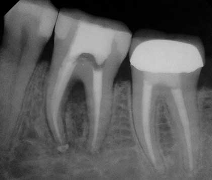 Прицельный снимок после пломбировки каналов зуба