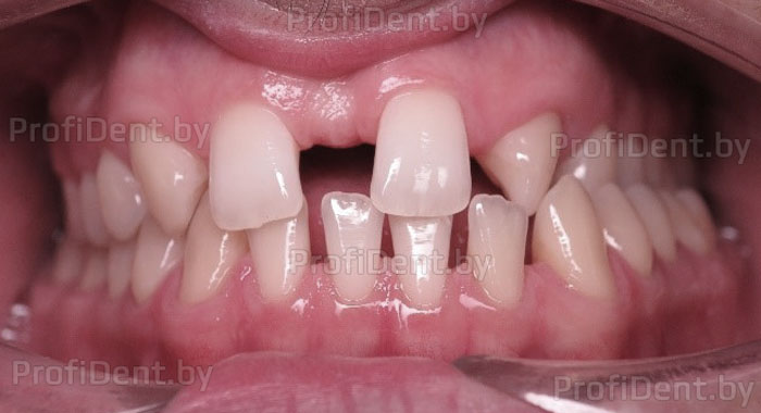 Исправление прикуса и имплантация в области отсутствующих вторых верхних зубов