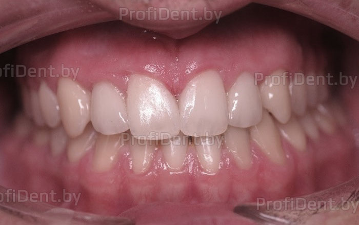 Исправление прикуса и имплантация в области отсутствующих вторых верхних зубов