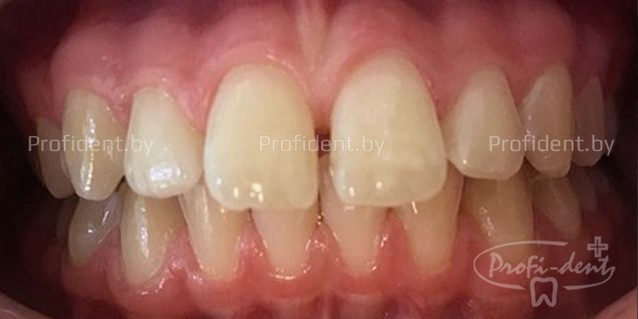 Как убрать щель между передними зубами?