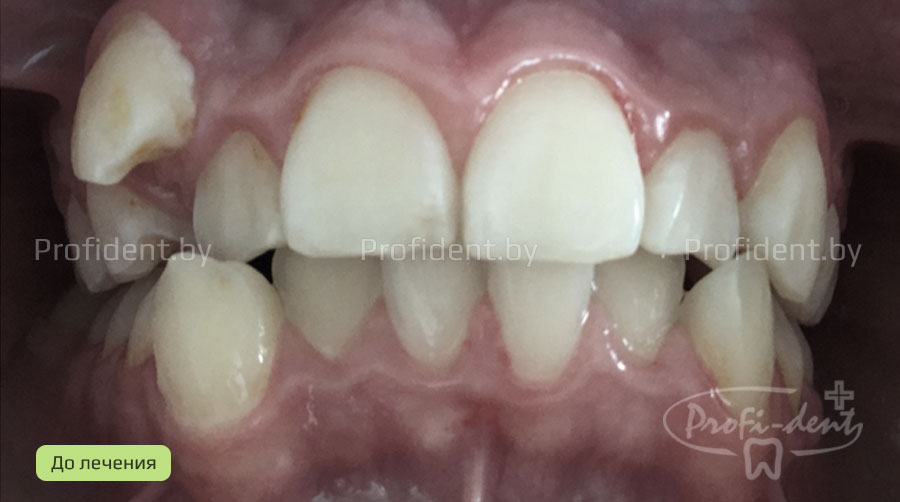 Ортодонтическое лечениe скученного положения передних зубов
