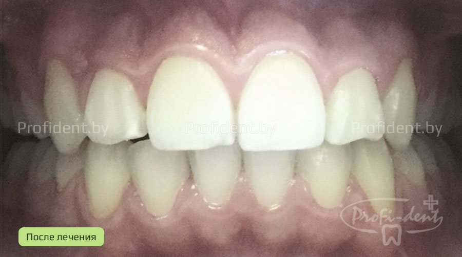 Ортодонтическое лечениe скученного положения передних зубов