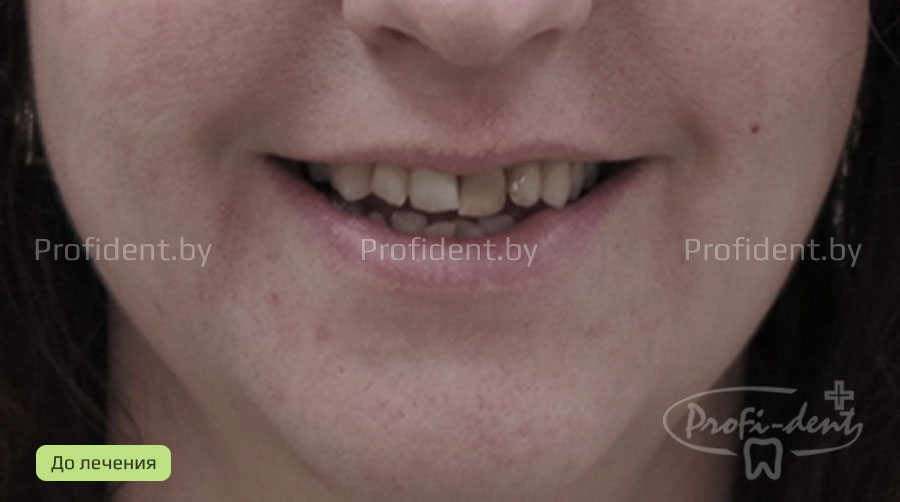 Устранение эстетического недостатка передних зубов