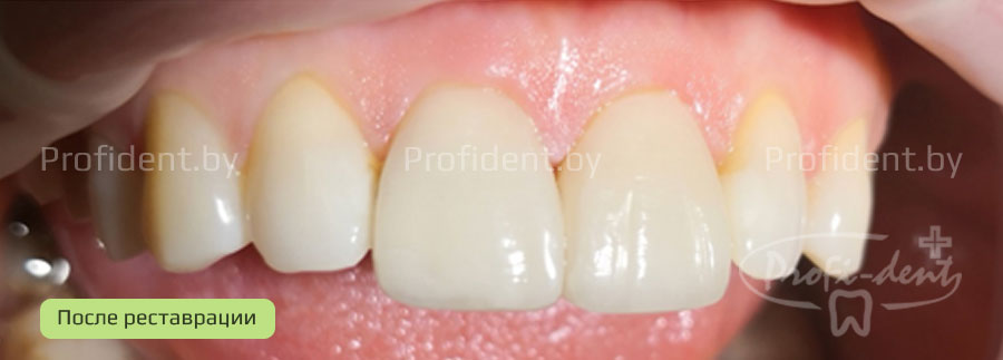Эстетическая реставрация и фотоотбеливание передних зубов
